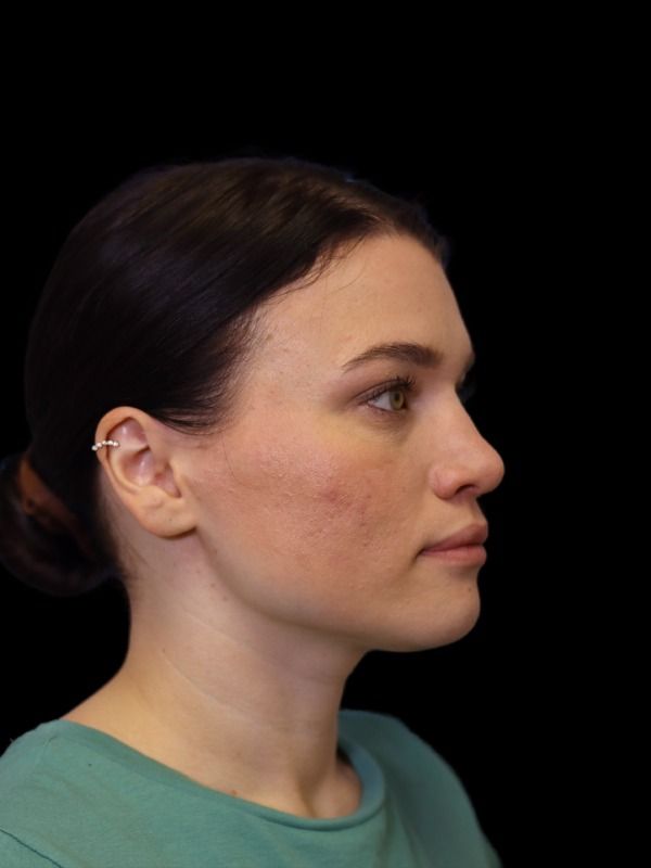 Rhinoplasty Before & After