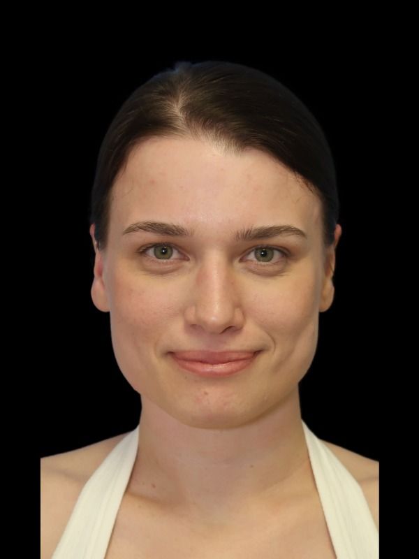 Rhinoplasty Before & After