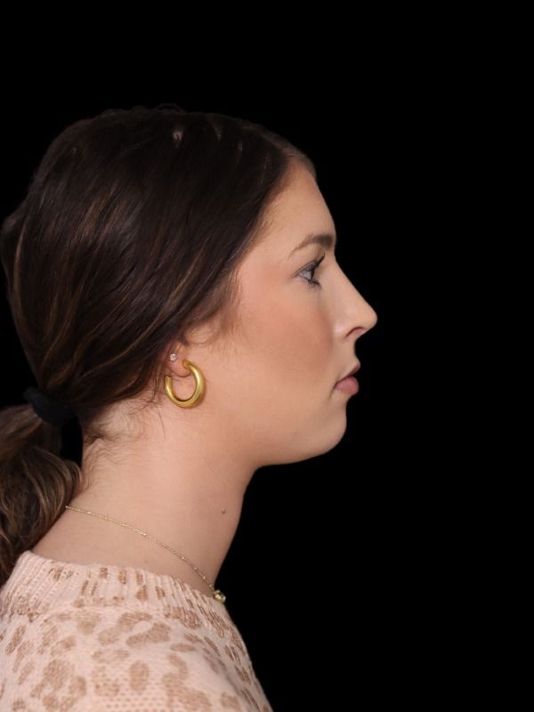 Rhinoplasty Before & After