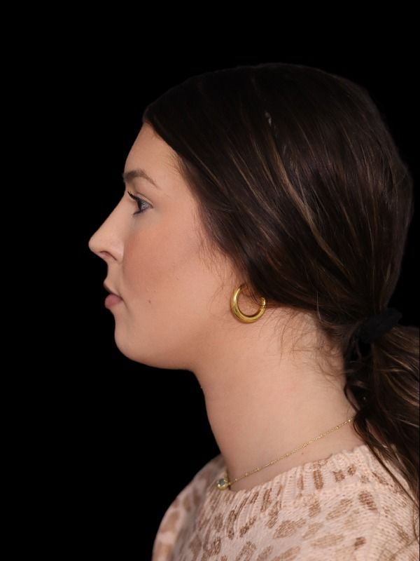 Rhinoplasty Before & After