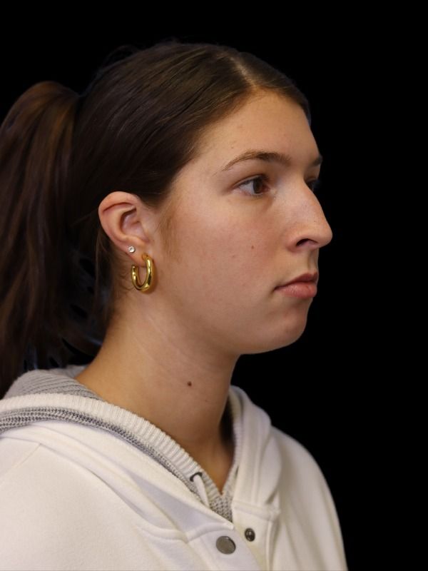 Rhinoplasty Before & After