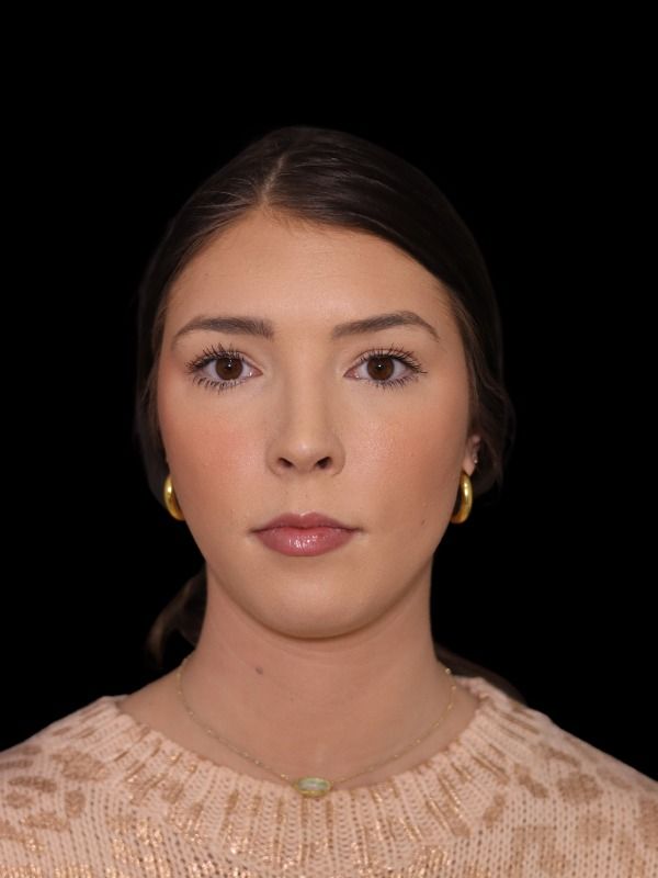 Rhinoplasty Before & After