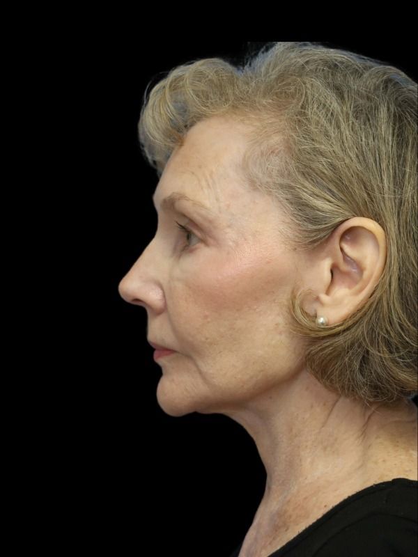 Rhinoplasty Before & After