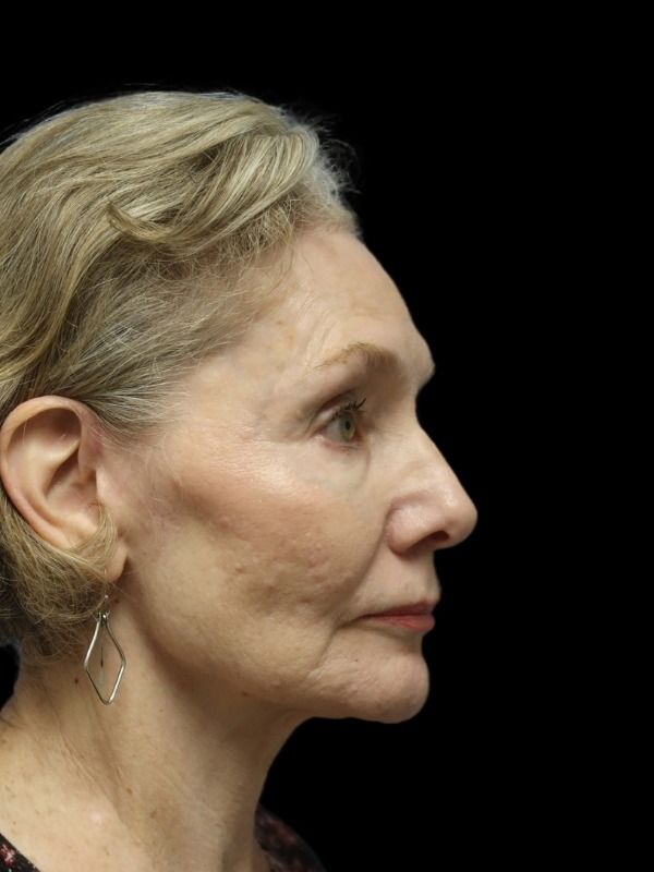 Rhinoplasty Before & After