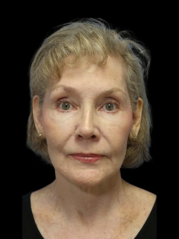 Rhinoplasty Before & After