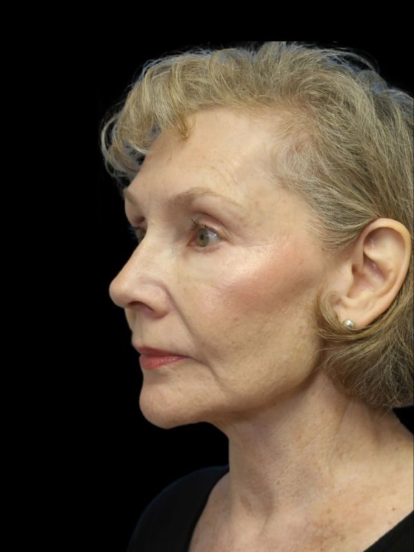 Rhinoplasty Before & After