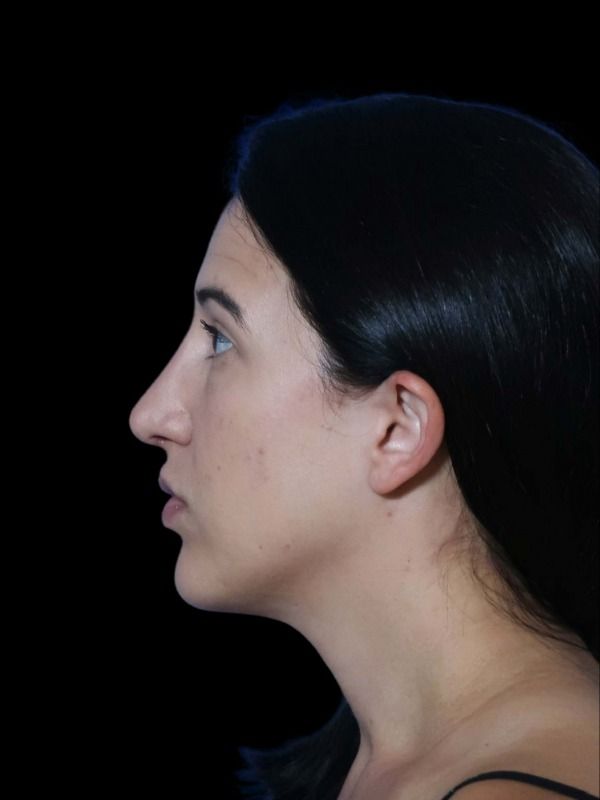 Rhinoplasty Before & After