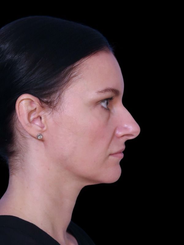 Rhinoplasty Before & After