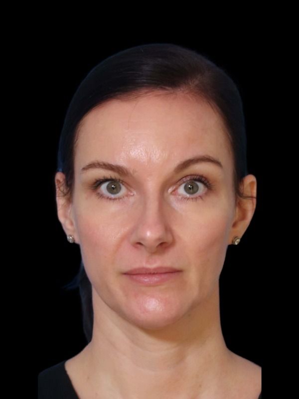 Rhinoplasty Before & After