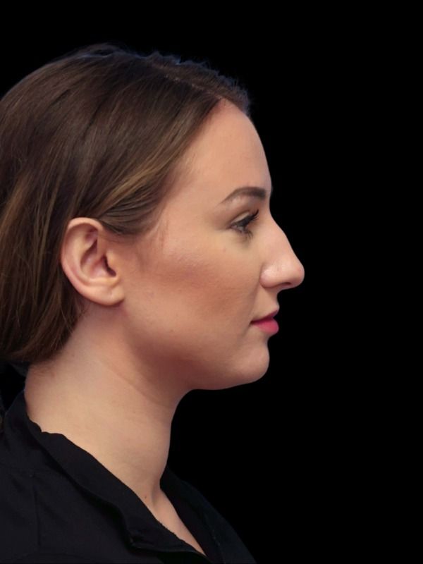 Rhinoplasty Before & After