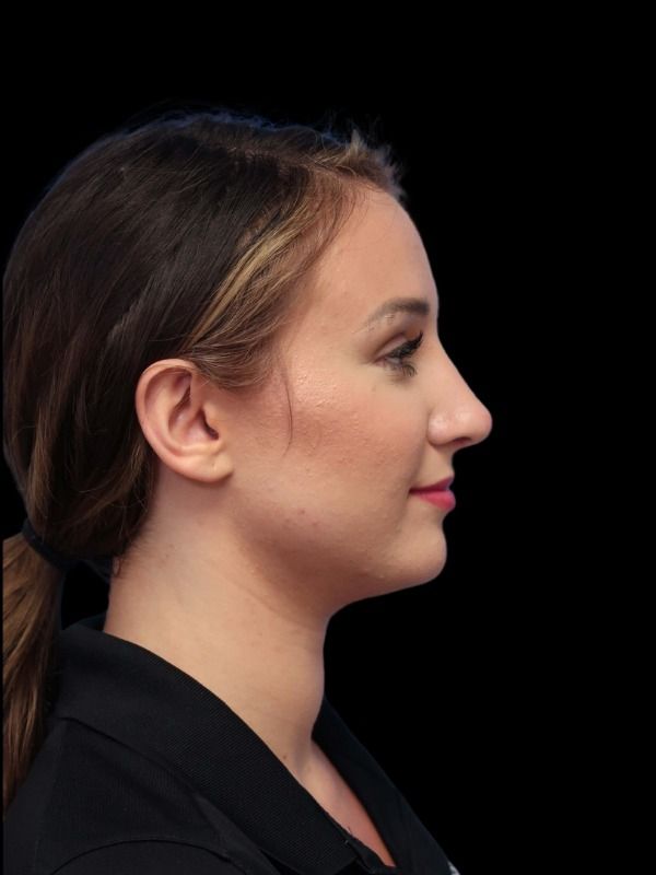 Rhinoplasty Before & After