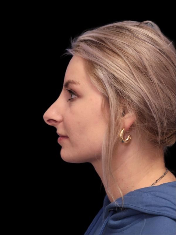 Rhinoplasty Before & After