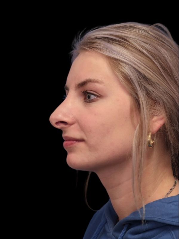 Rhinoplasty Before & After