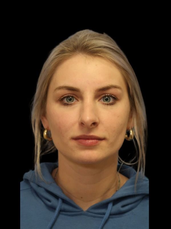 Rhinoplasty Before & After