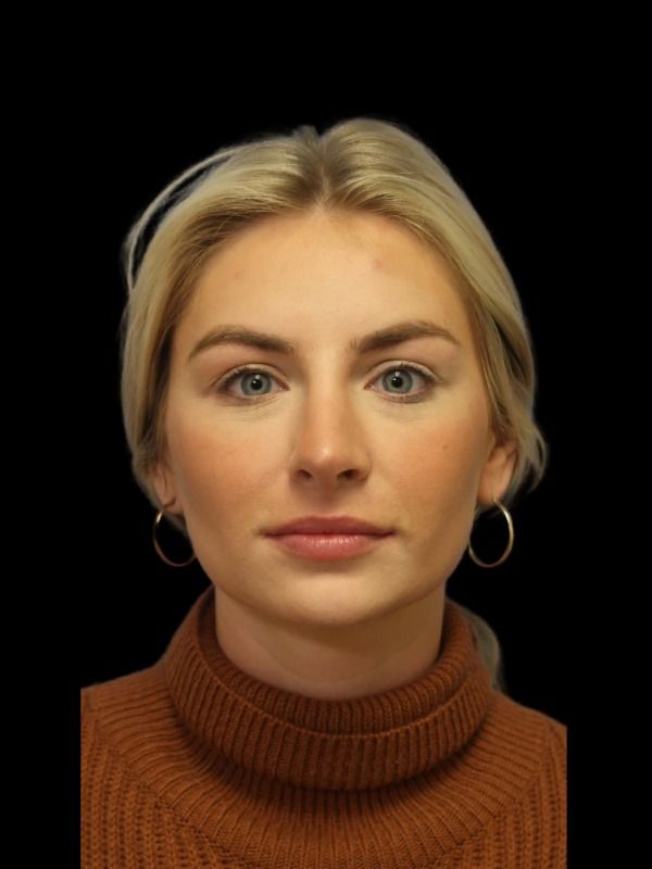 Rhinoplasty Before & After