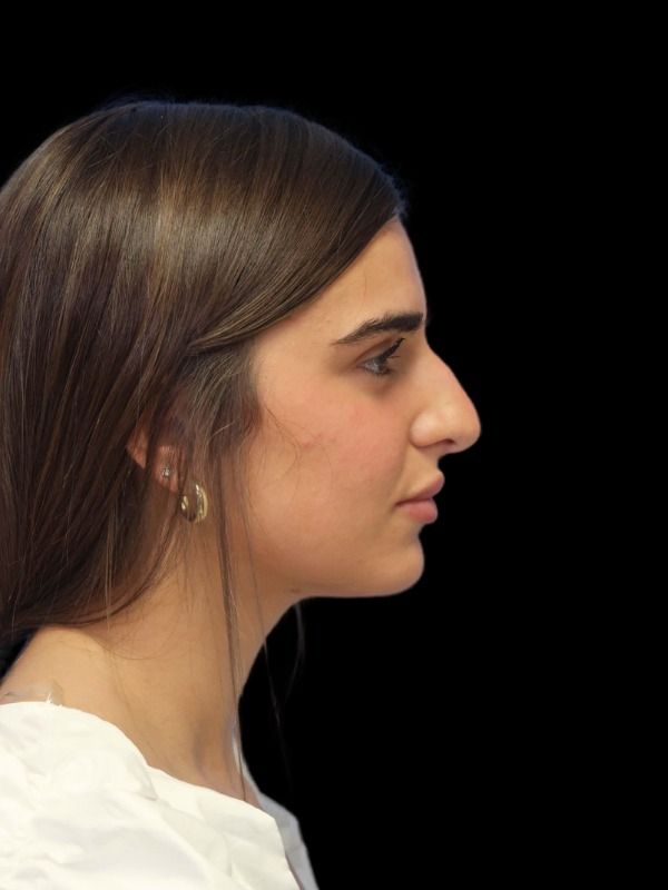 Rhinoplasty Before & After
