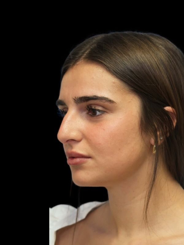 Rhinoplasty Before & After