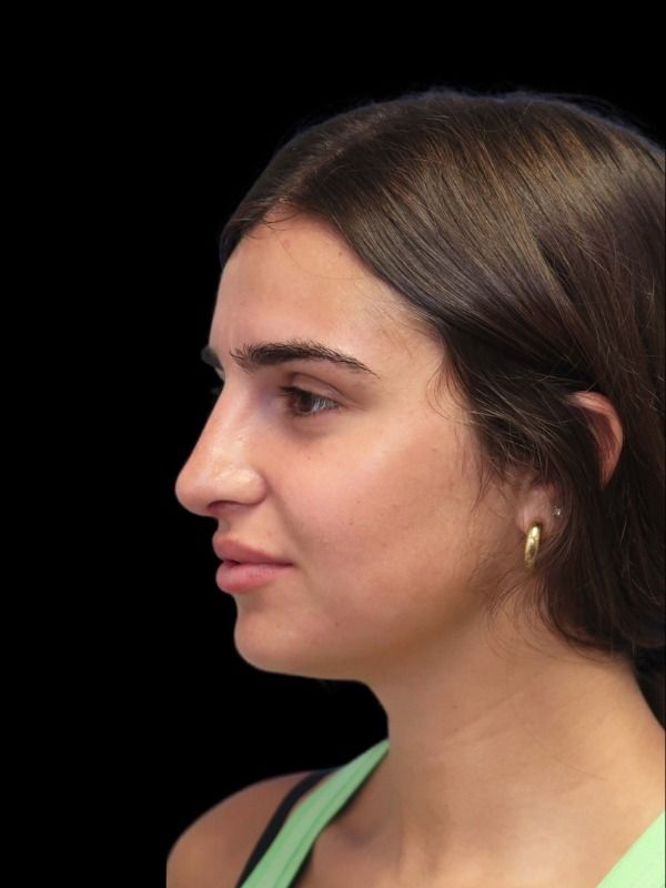 Rhinoplasty Before & After