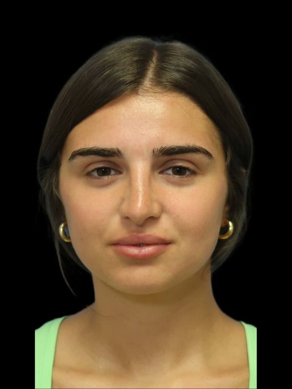 Rhinoplasty Before & After