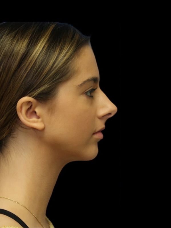 Rhinoplasty Before & After