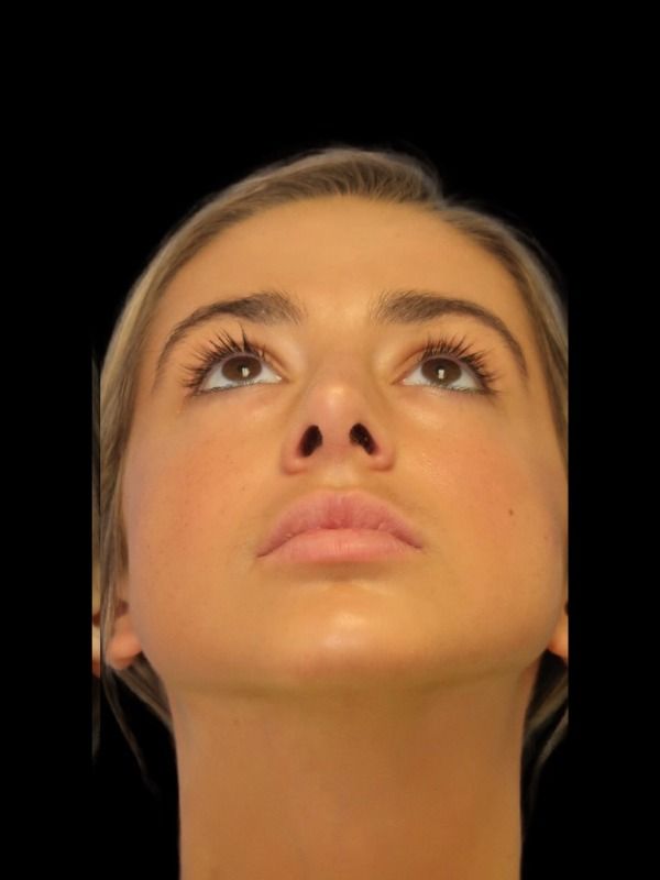 Rhinoplasty Before & After