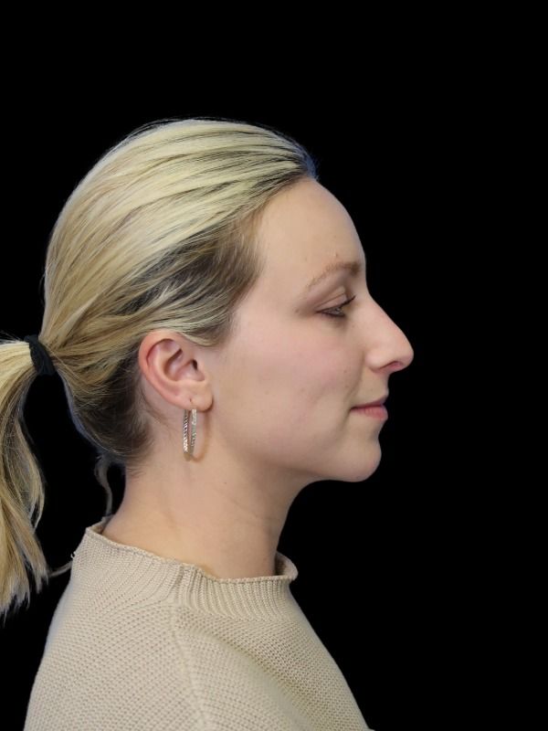Rhinoplasty Before & After