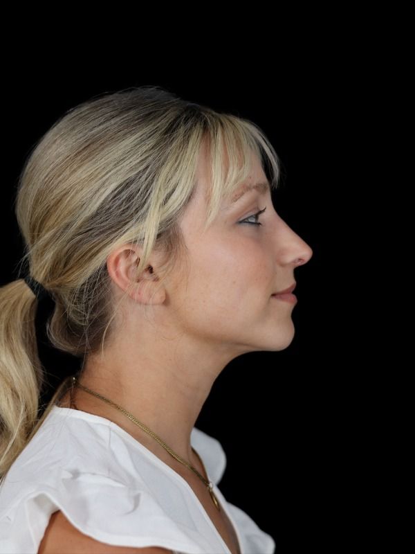 Rhinoplasty Before & After