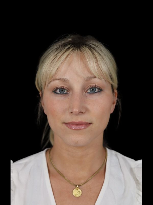 Rhinoplasty Before & After