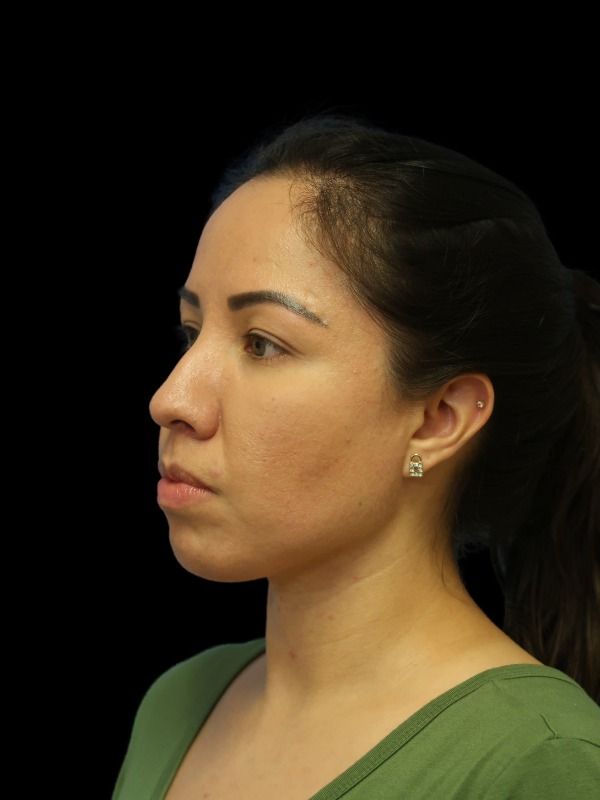 Rhinoplasty Before & After