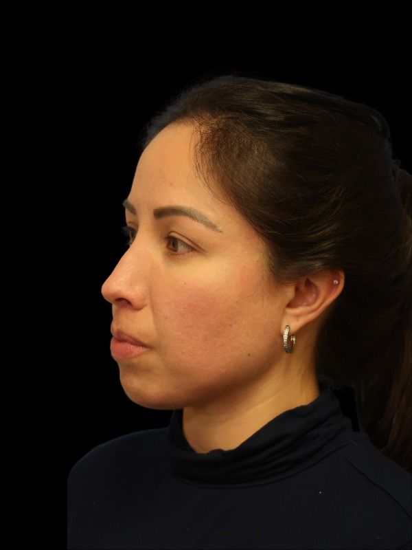 Rhinoplasty Before & After