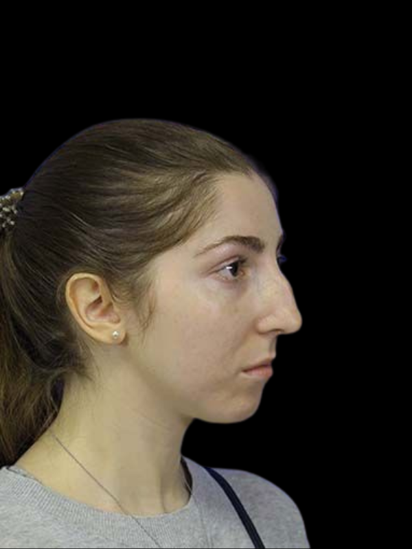 Rhinoplasty Before & After