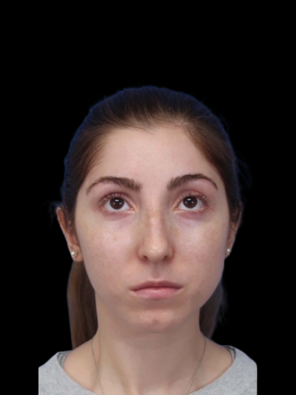 Rhinoplasty Before & After