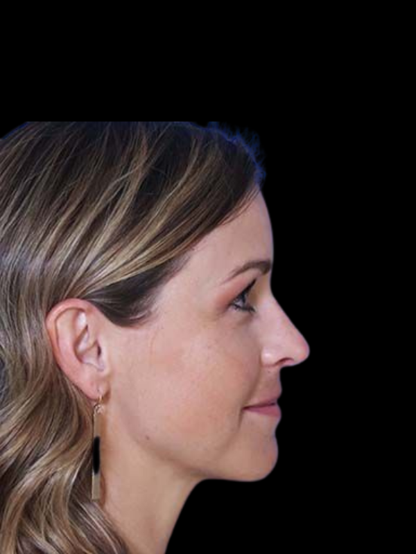 Rhinoplasty Before & After