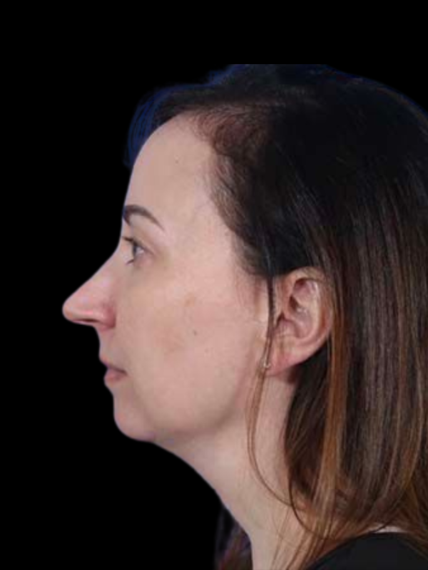 Rhinoplasty Before & After