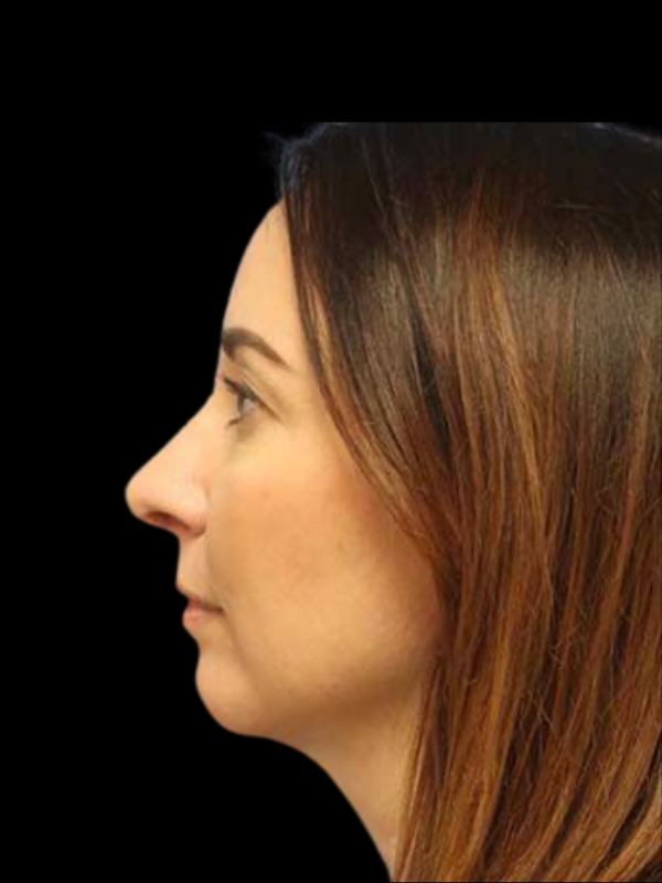Rhinoplasty Before & After