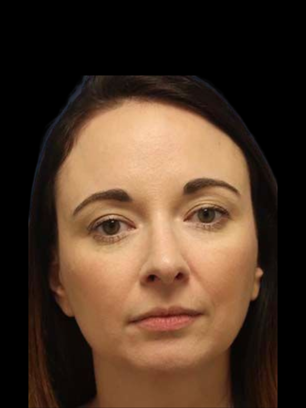 Rhinoplasty Before & After