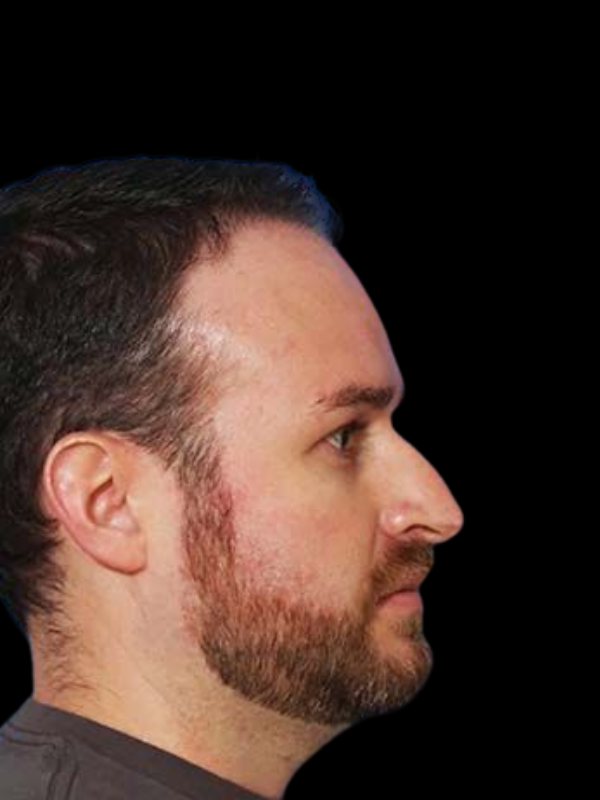 Rhinoplasty Before & After