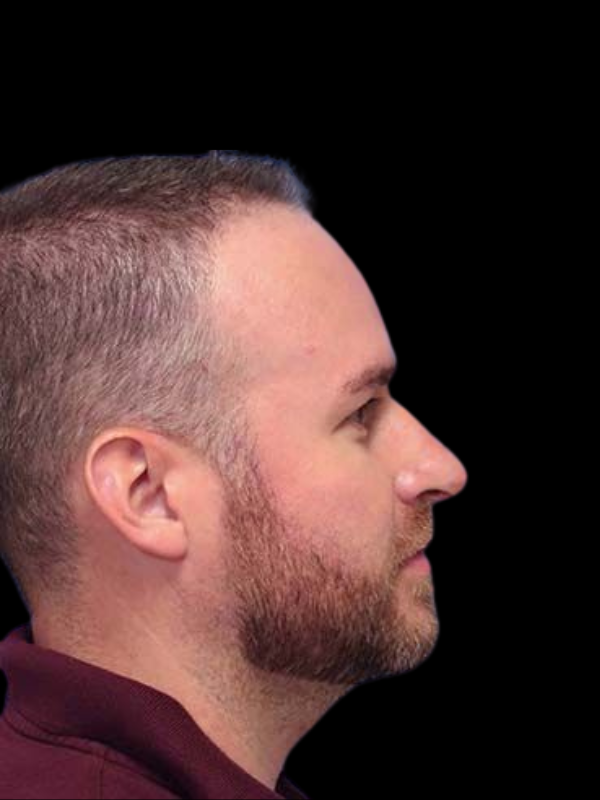 Rhinoplasty Before & After