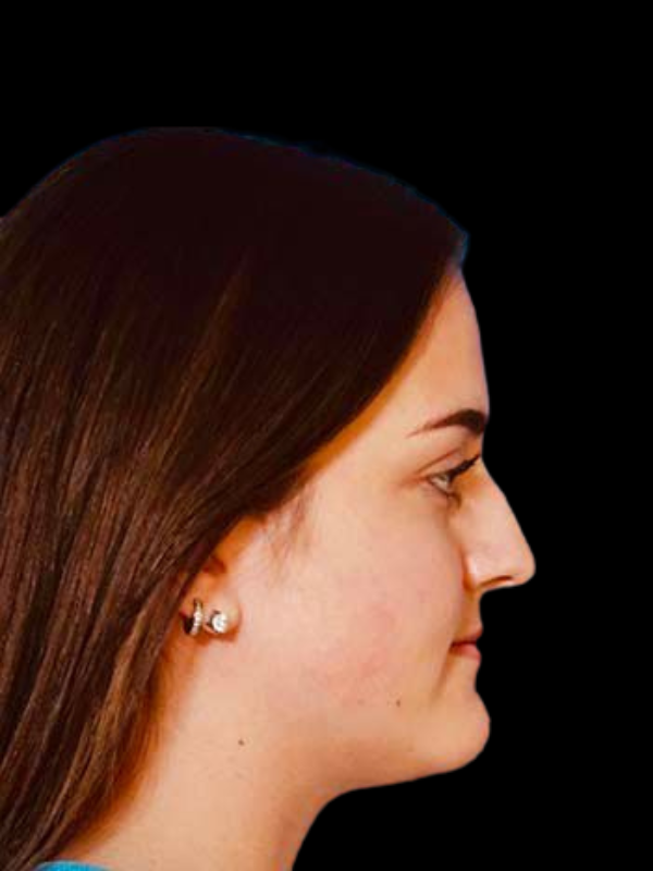 Rhinoplasty Before & After