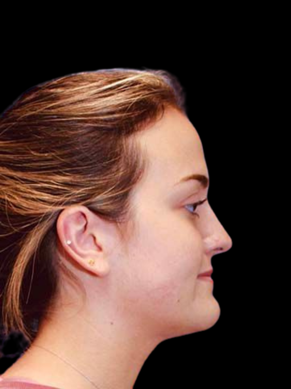 Rhinoplasty Before & After