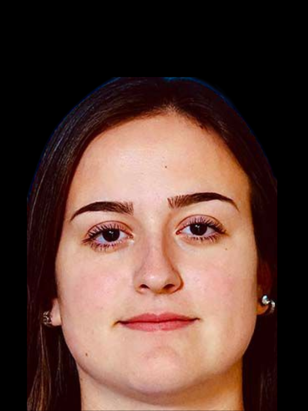 Rhinoplasty Before & After