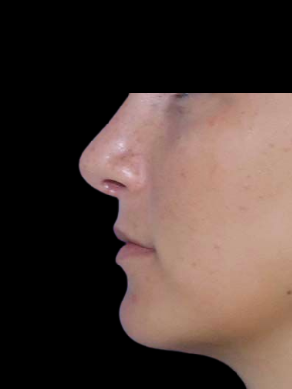 Rhinoplasty Before & After