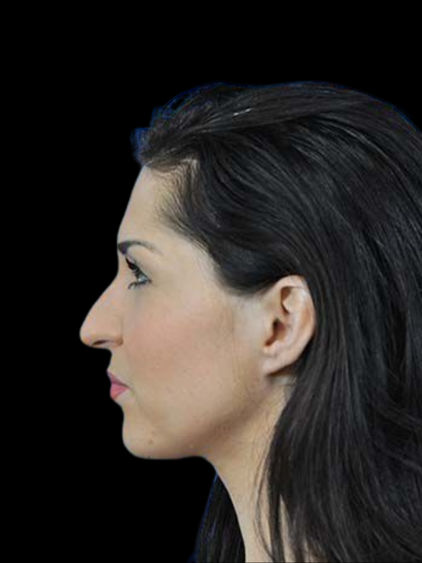 Rhinoplasty Before & After