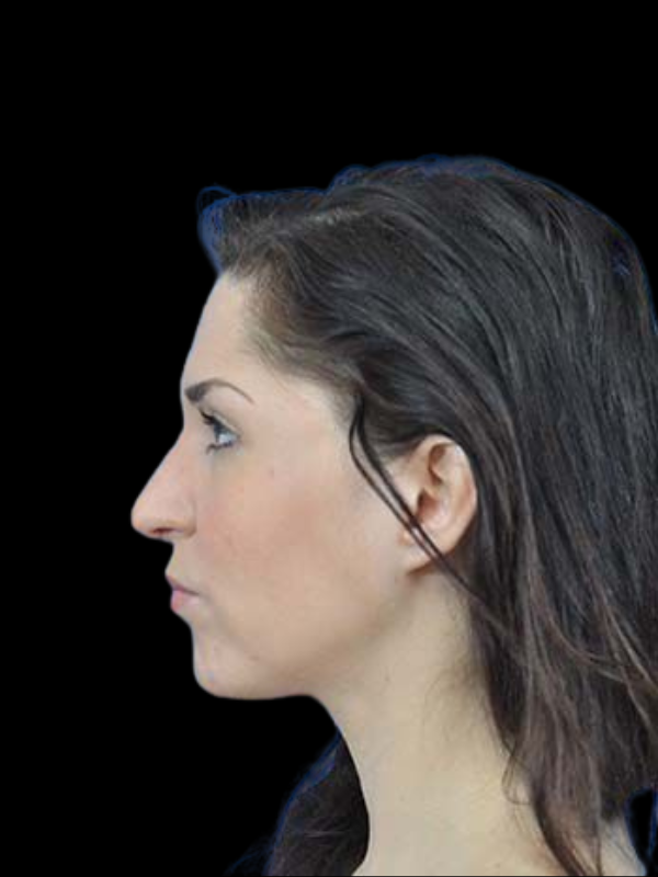 Rhinoplasty Before & After