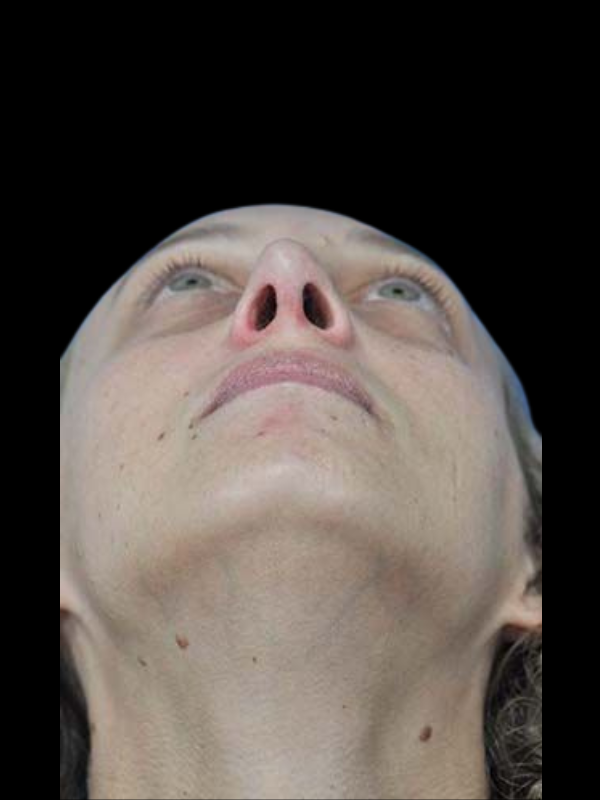 Rhinoplasty Before & After