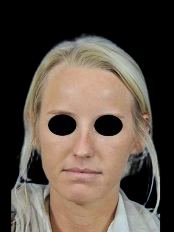 Rhinoplasty Before & After