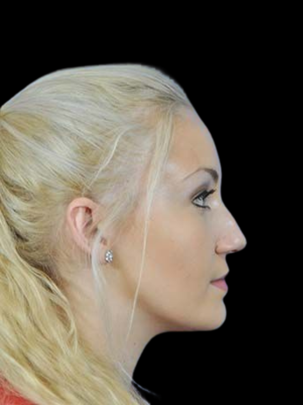 Rhinoplasty Before & After