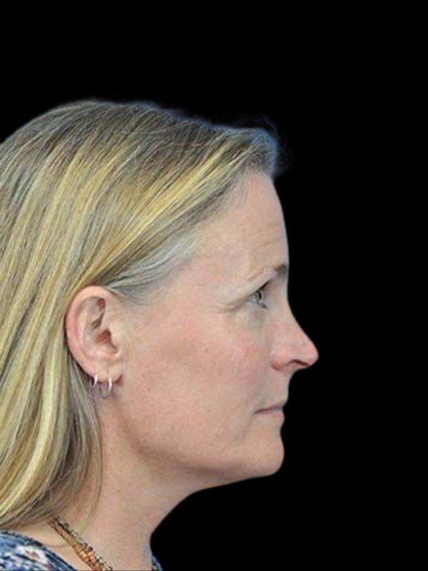 Rhinoplasty Before & After