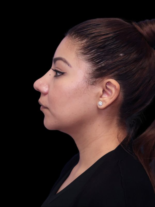 Rhinoplasty Before & After