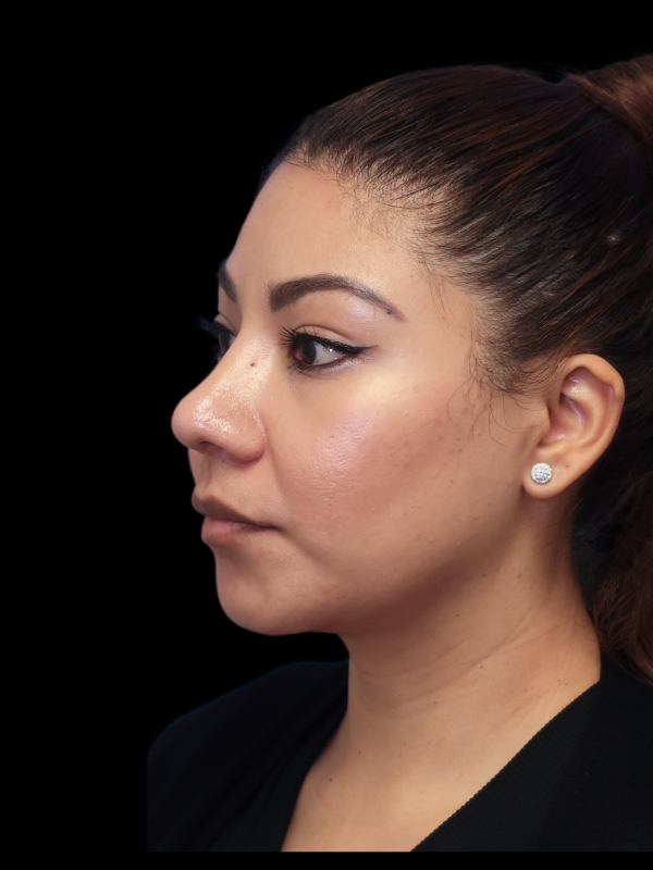Rhinoplasty Before & After